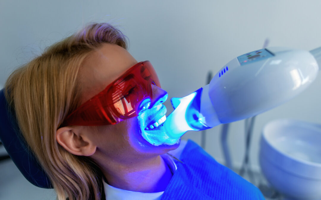 Benefits of Professional Teeth Whitening