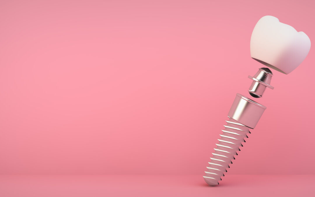 The Advantages of Dental Implants Over Traditional Dentures