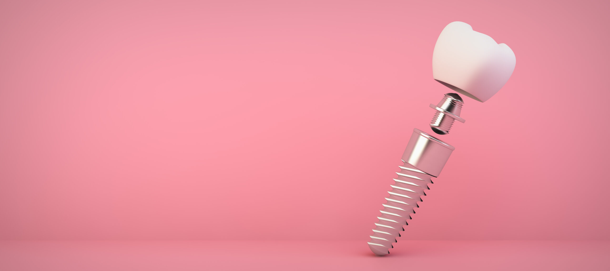 Expert dental implants in Stoney Creek for a confident smile at Lakeside Dental