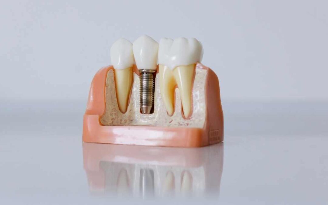 Dental Implants: The Crucial Connection to Bone Health