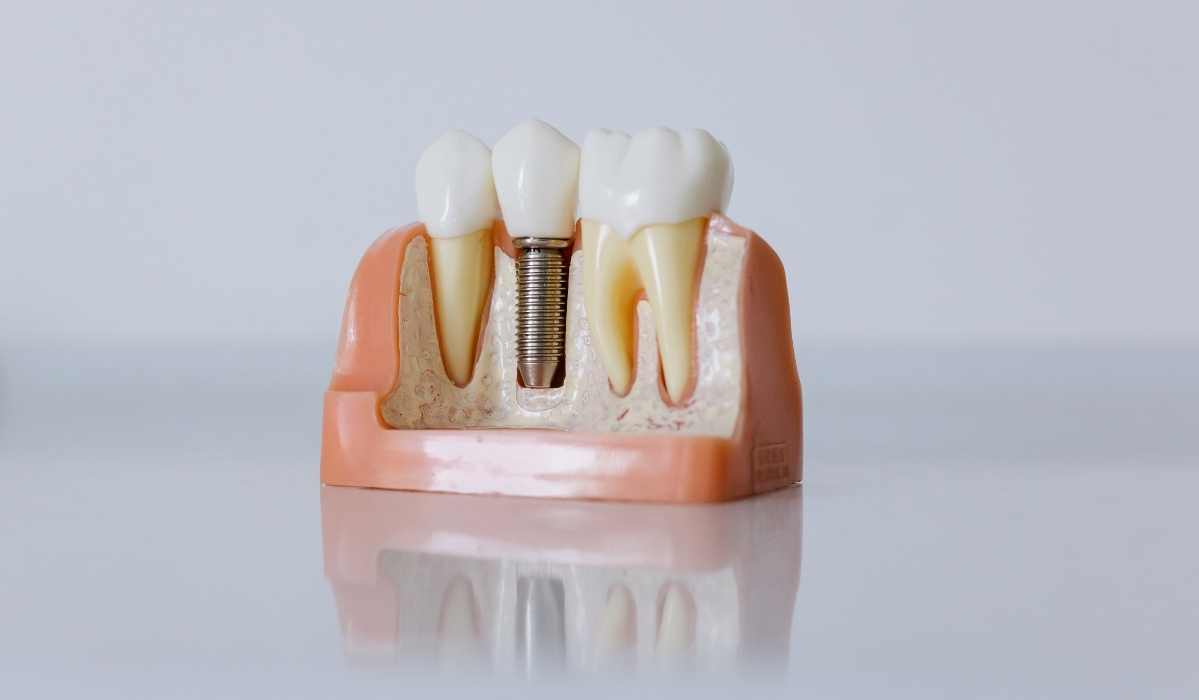 Dental implants preserving jawbone health at Lakeside Dental Stoney Creek