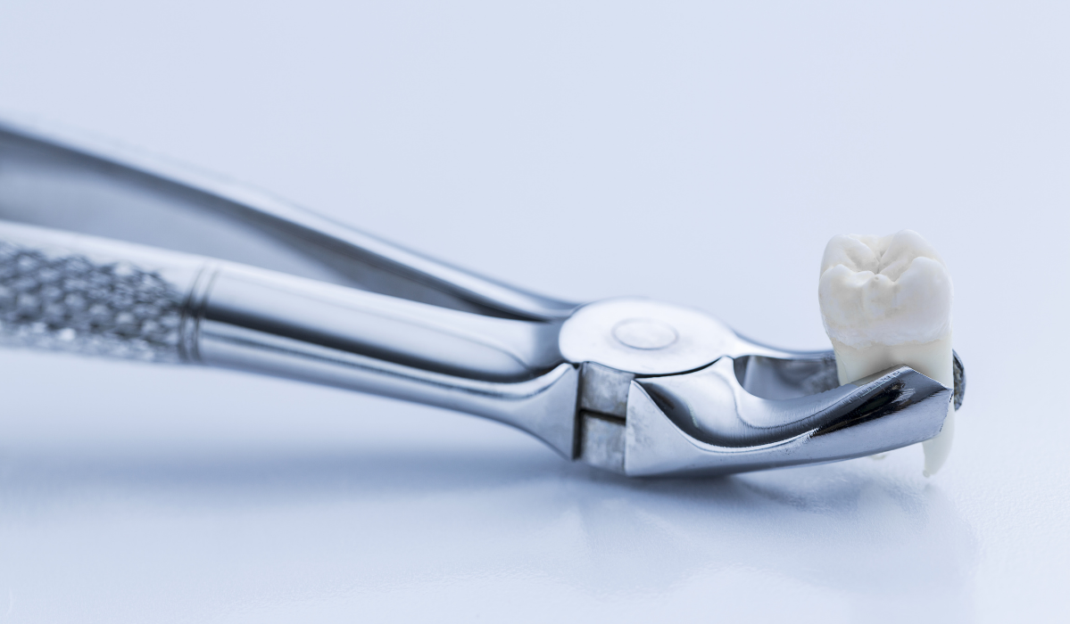 Tooth extraction consultation for wisdom teeth at Lakeside Dental with young adult patient