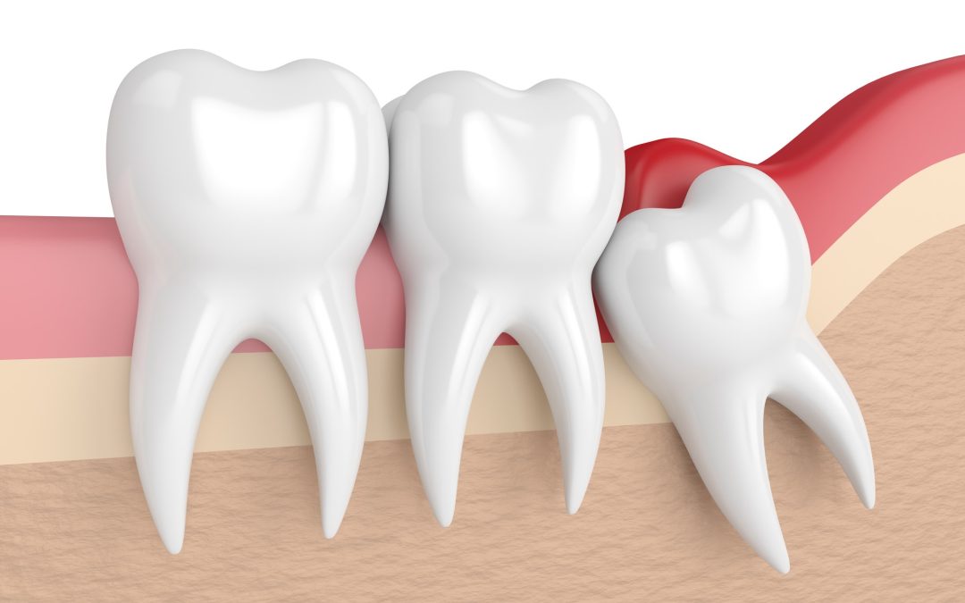 Tooth Extraction: Why Timing Matters for Wisdom Teeth