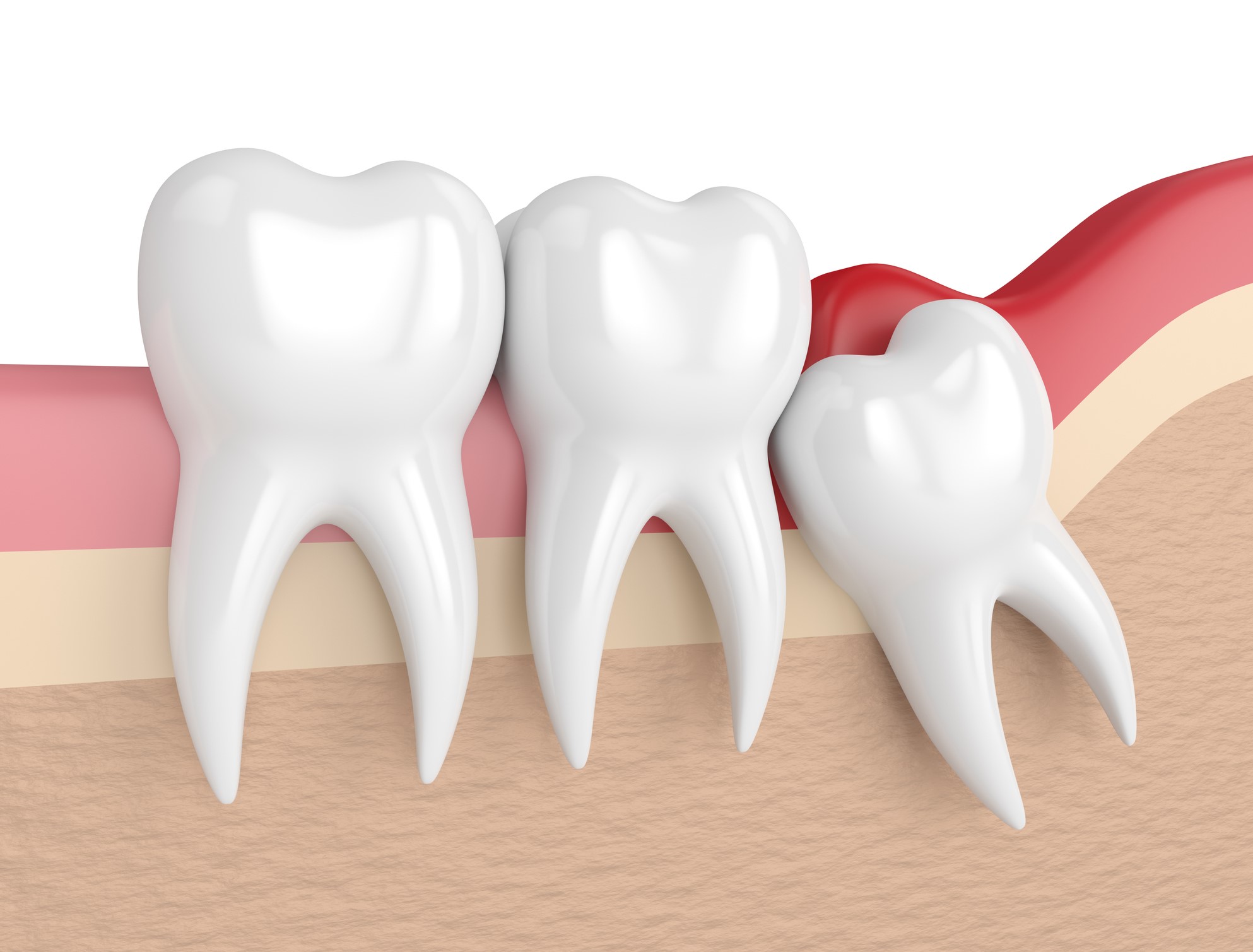 wisdom teeth extractions