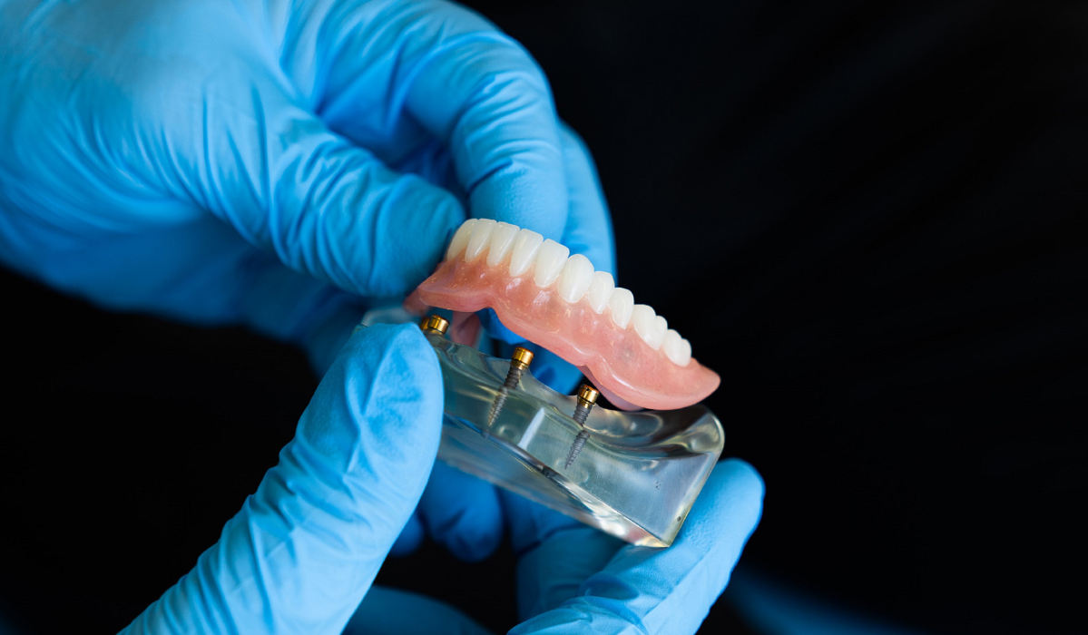 Dental implants comparison with dentures consultation at Lakeside Dental