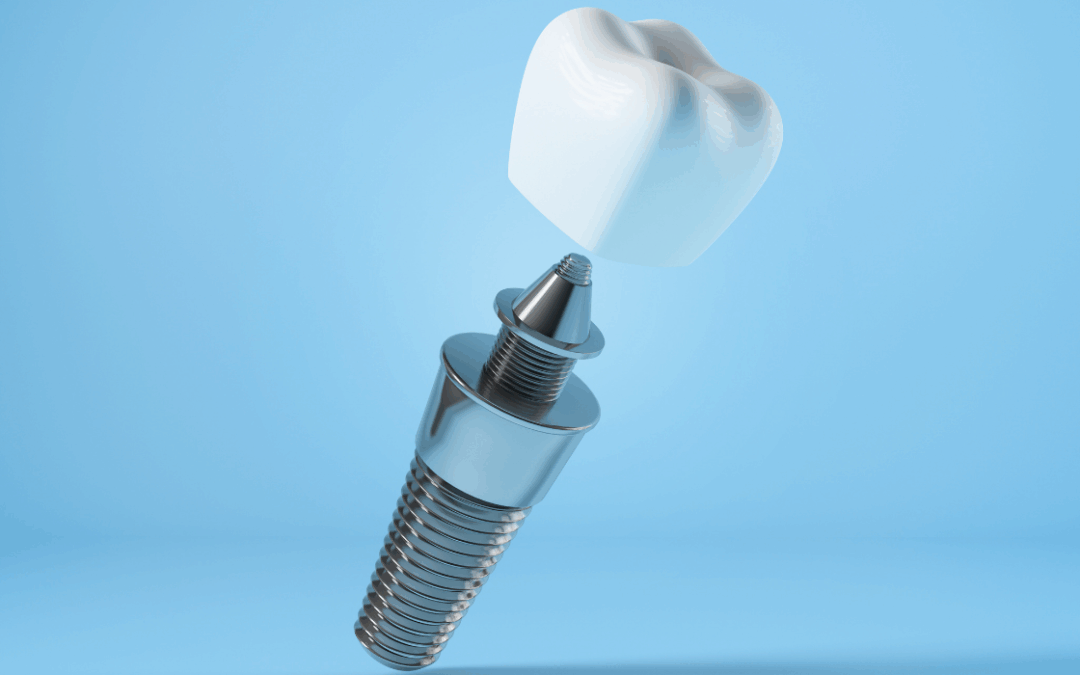 Dental Implants: Step-by-Step Procedure Guide