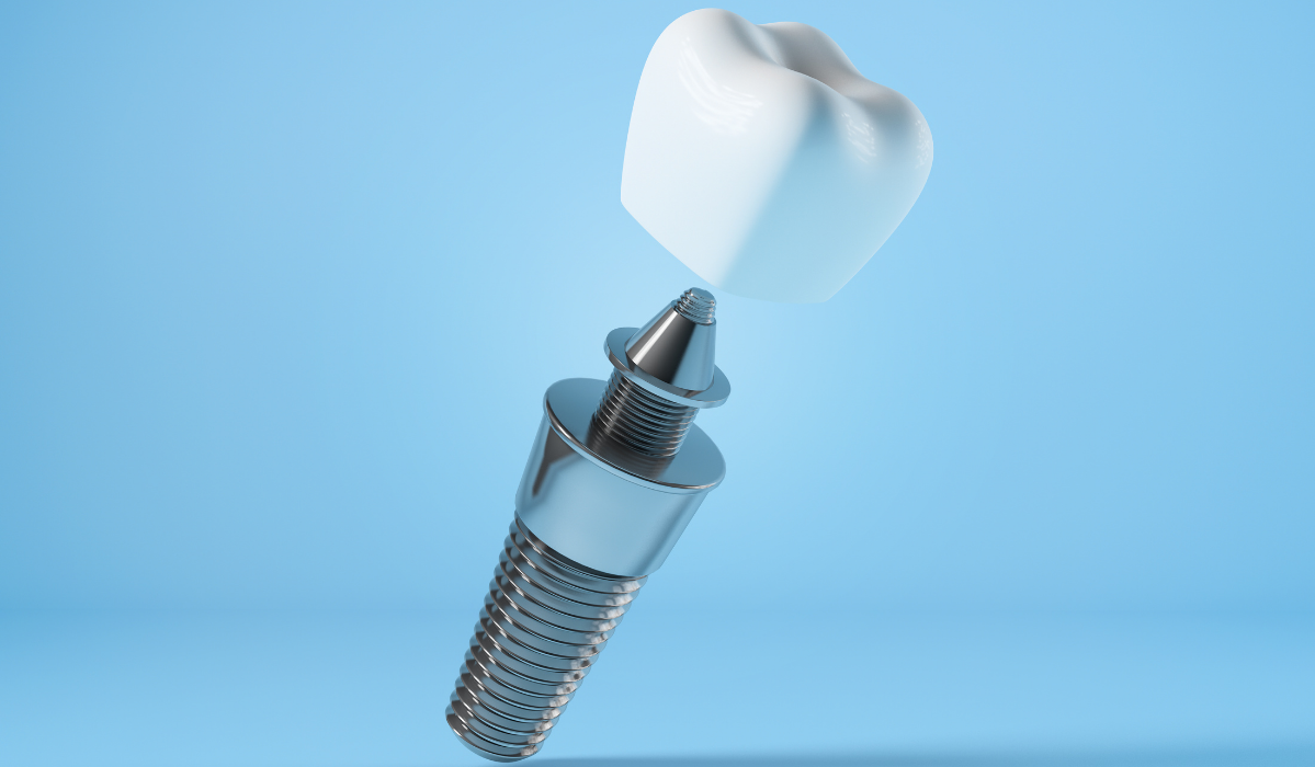 Dental implants procedure demonstration at Lakeside Dental Nov 2025 Dental implants procedure demonstration at Lakeside Dental showing step-by-step placement process