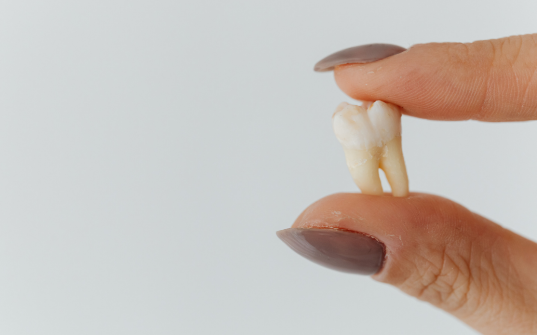 Tooth Extraction: Preventing Dry Socket and Other Complications