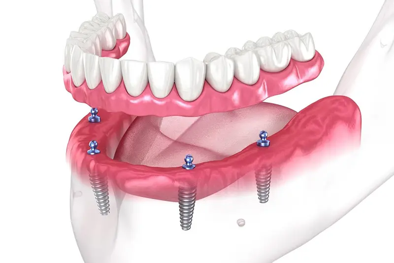 Full arch restoration specialist for All-on-X in Stoney Creek at Lakeside Dental<br />
